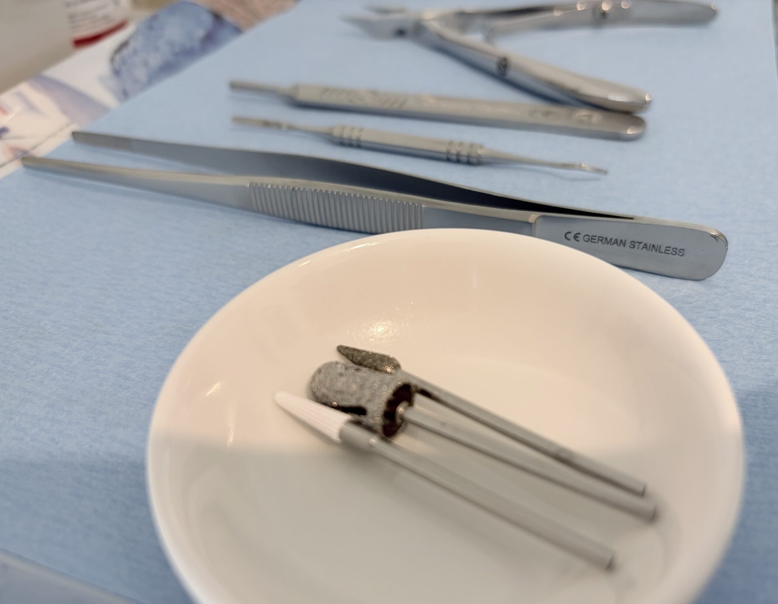 likdoorns, eelt, kloven, schimmelnagels, een ingroeide teennagel. Medisch pedicure in Breda